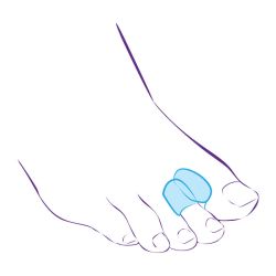 СТ-54.3 (L) Межпальцевая перегородка с кольцом